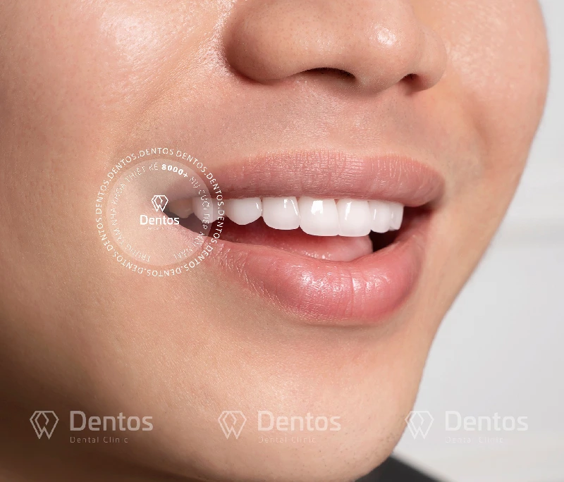 Răng sứ không thể mô phỏng chính xác 100% như răng thật